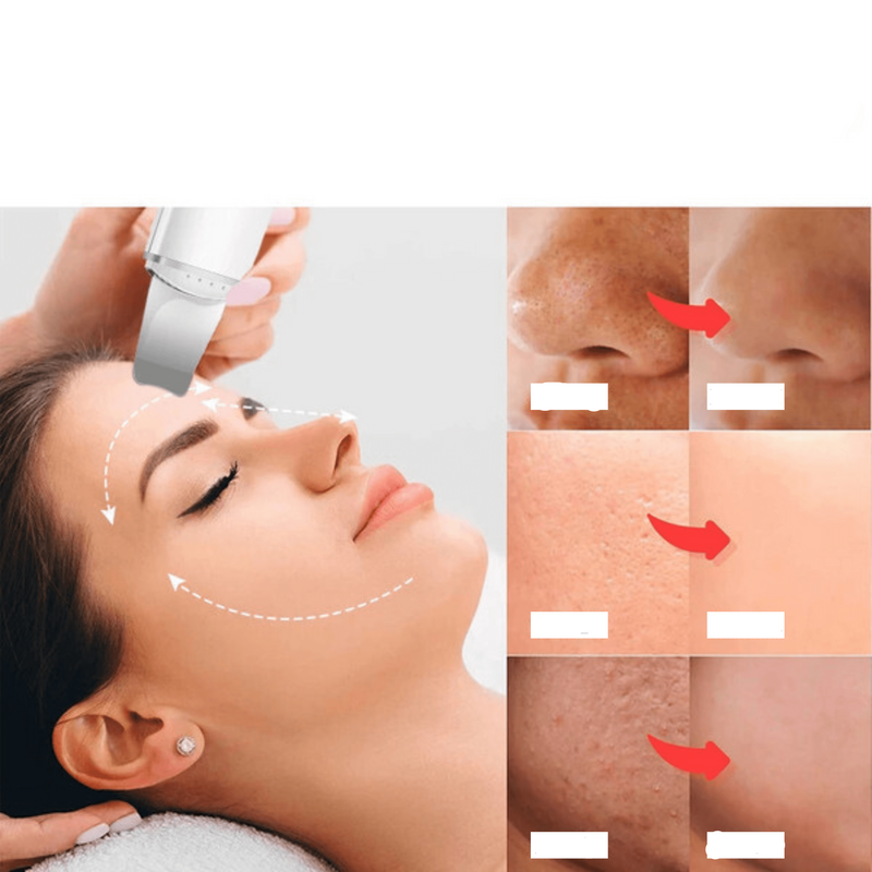 BellaSkin – Esfoliador Ultrassônico – Pele Limpa e Radiante